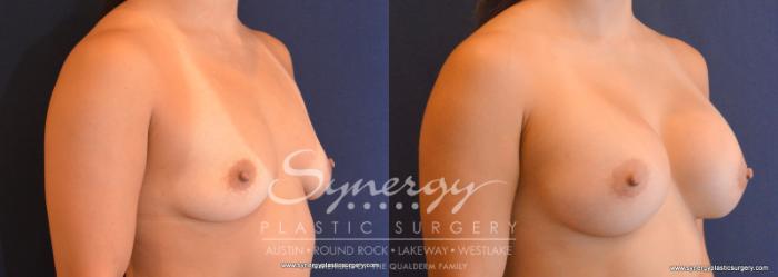 Before & After Breast Augmentation Case 616 View #4 View in Austin, TX