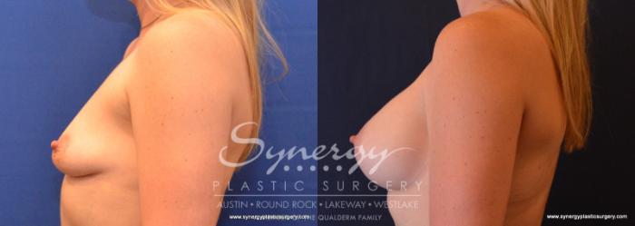 Before & After Breast Augmentation Case 618 View #3 View in Austin, TX