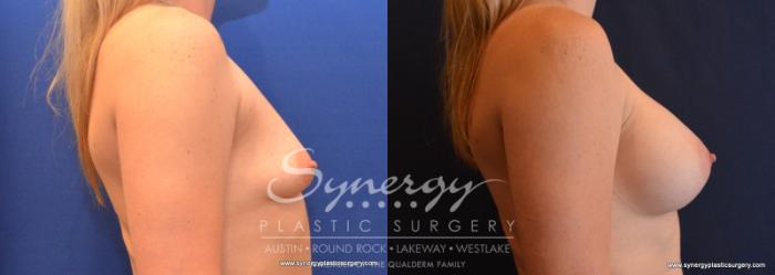 Before & After Breast Augmentation Case 618 View #5 View in Austin, TX