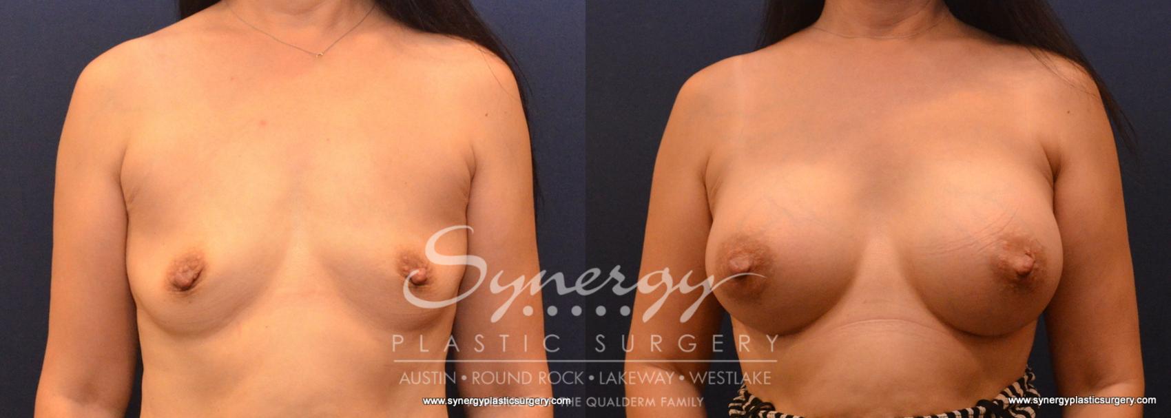 Before & After Breast Augmentation Case 619 View #1 View in Austin, TX