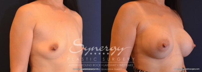 Before & After Breast Augmentation Case 619 View #2 View in Austin, TX