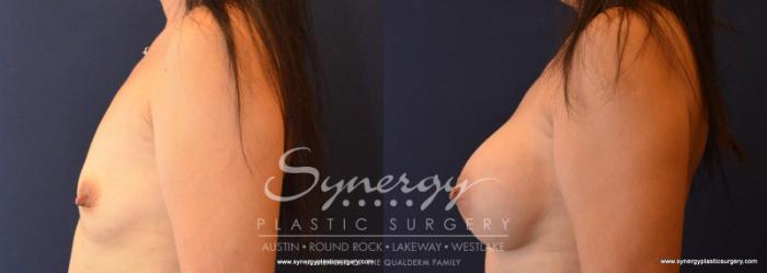 Before & After Breast Augmentation Case 619 View #5 View in Austin, TX