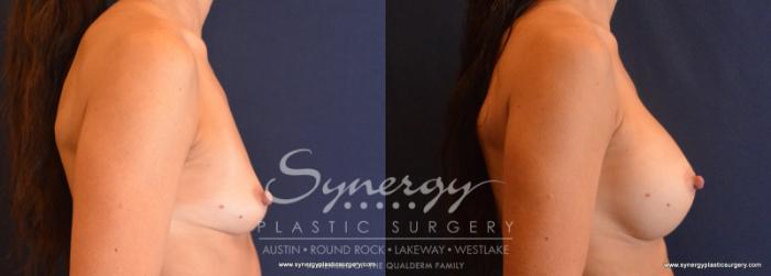 Before & After Breast Augmentation Case 620 View #5 View in Austin, TX