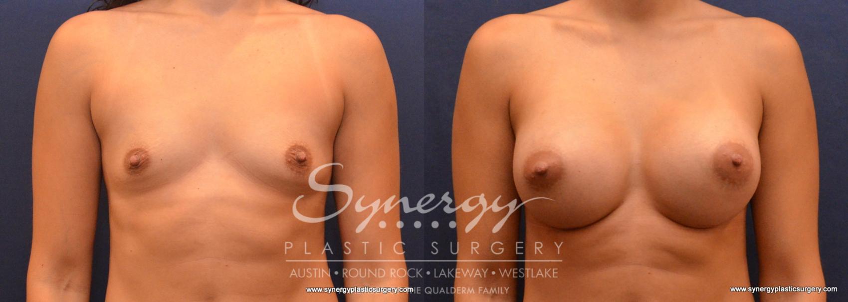 Before & After Breast Augmentation Case 622 View #1 View in Austin, TX