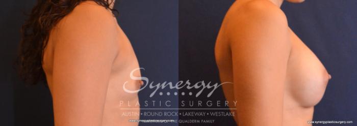 Before & After Breast Augmentation Case 622 View #3 View in Austin, TX