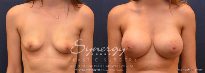 Before & After Breast Augmentation Case 623 View #1 View in Austin, TX