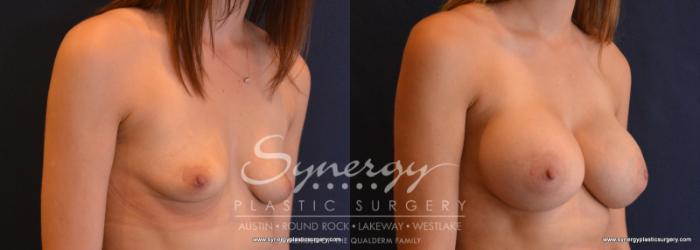 Before & After Breast Augmentation Case 623 View #4 View in Austin, TX