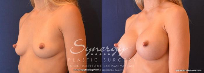 Before & After Breast Augmentation Case 625 View #2 View in Austin, TX