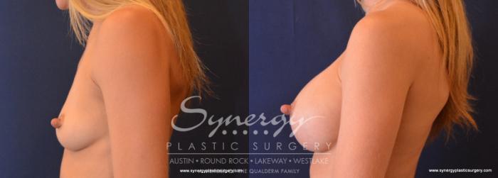 Before & After Breast Augmentation Case 625 View #3 View in Austin, TX