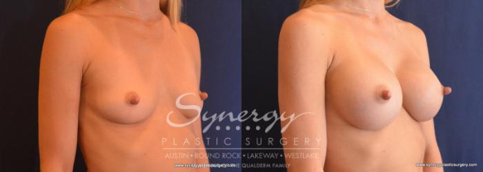 Before & After Breast Augmentation Case 625 View #5 View in Austin, TX