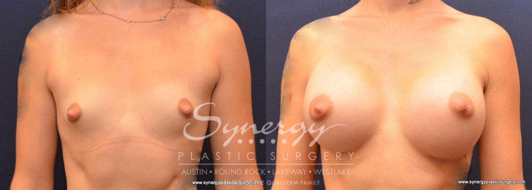Before & After Breast Augmentation Case 626 View #1 View in Austin, TX