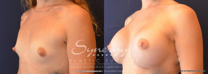 Before & After Breast Augmentation Case 626 View #2 View in Austin, TX