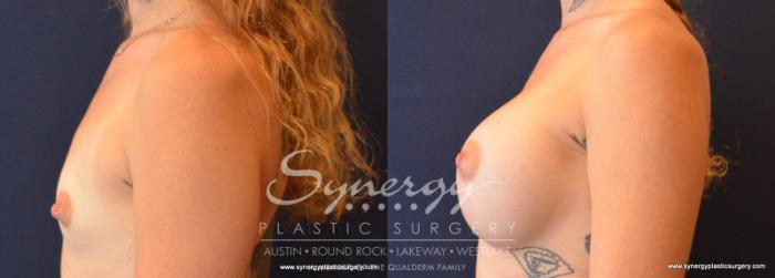 Before & After Breast Augmentation Case 626 View #3 View in Austin, TX
