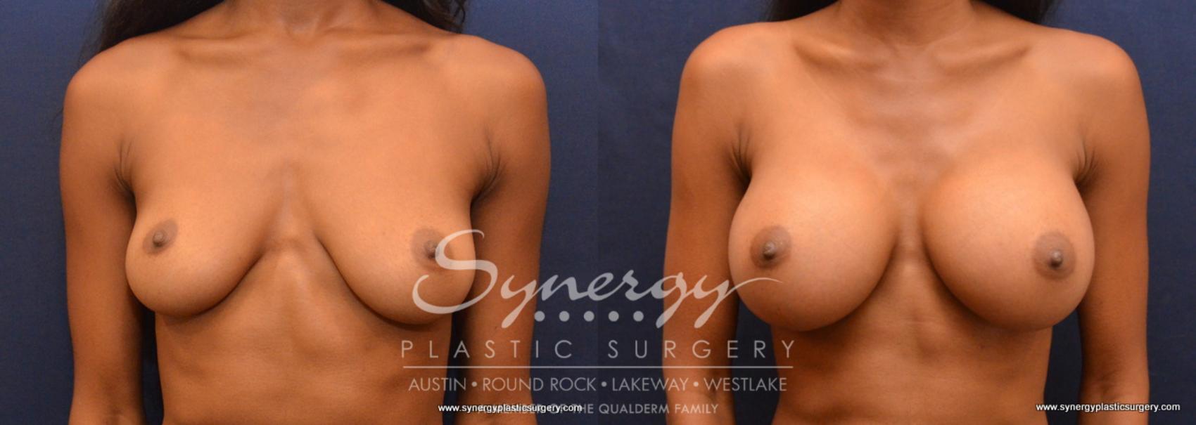 Before & After Breast Augmentation Case 633 View #1 View in Austin, TX