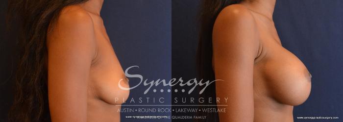 Before & After Breast Augmentation Case 633 View #2 View in Austin, TX