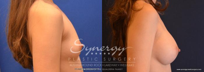 Before & After Breast Augmentation Case 634 View #3 View in Austin, TX
