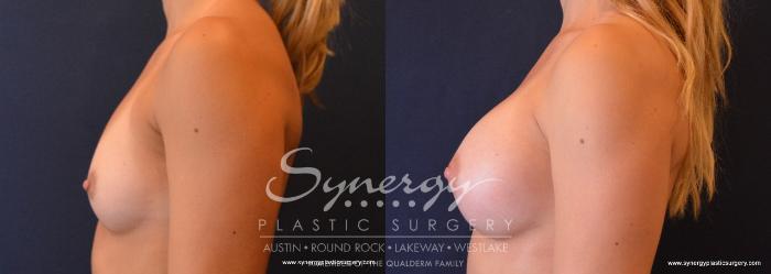 Before & After Breast Augmentation Case 636 View #3 View in Austin, TX