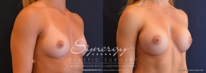 Before & After Breast Augmentation Case 636 View #4 View in Austin, TX