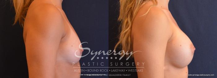 Before & After Breast Augmentation Case 636 View #5 View in Austin, TX