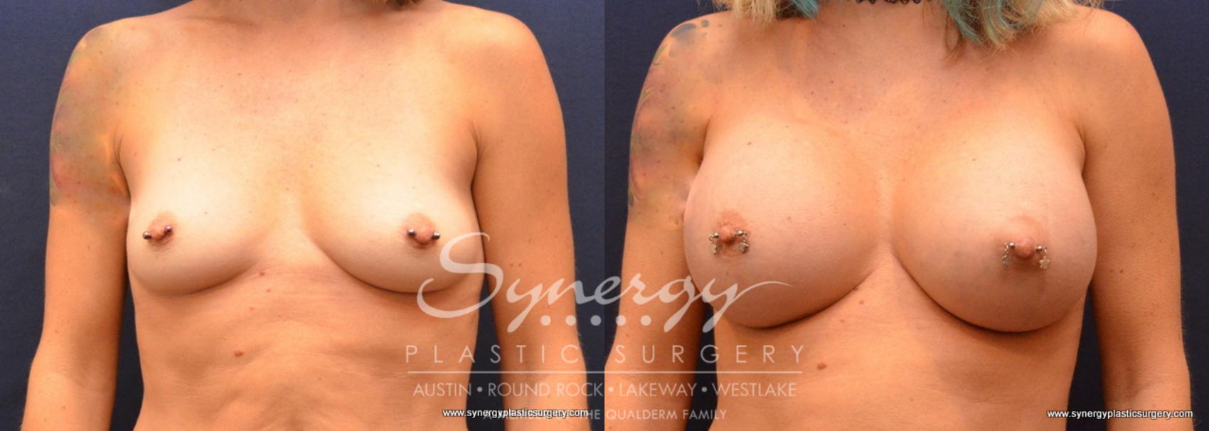 Before & After Breast Augmentation Case 637 View #1 View in Austin, TX