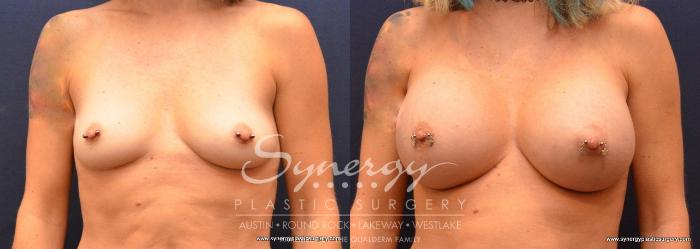 Before & After Breast Augmentation Case 637 View #1 View in Austin, TX
