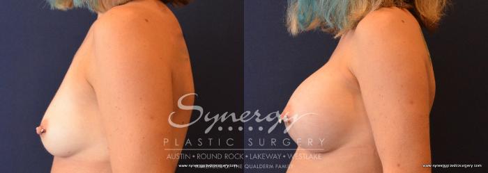 Before & After Breast Augmentation Case 637 View #2 View in Austin, TX