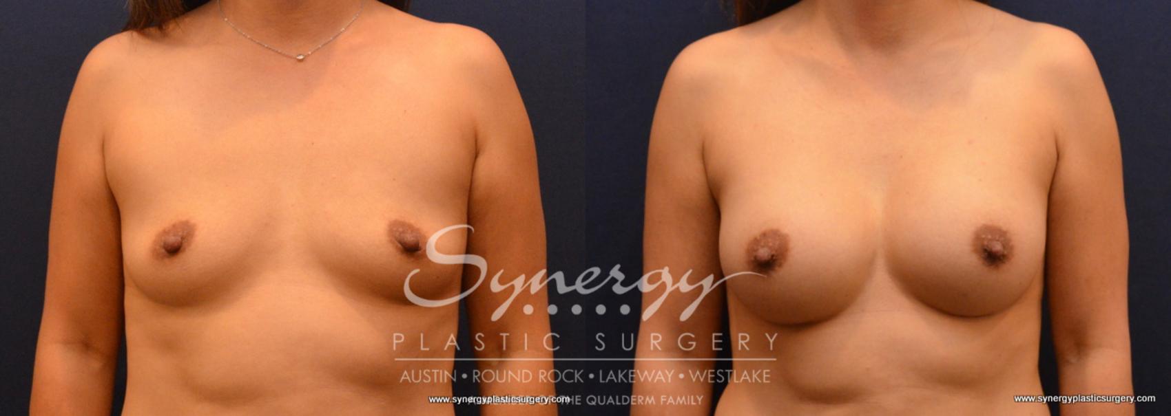 Before & After Breast Augmentation Case 639 View #1 View in Austin, TX
