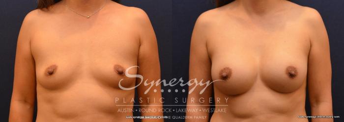 Before & After Breast Augmentation Case 639 View #1 View in Austin, TX