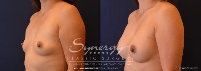 Before & After Breast Augmentation Case 639 View #2 View in Austin, TX