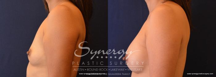 Before & After Breast Augmentation Case 639 View #3 View in Austin, TX