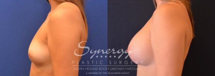 Before & After Breast Augmentation Case 642 View #3 View in Austin, TX