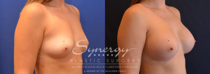 Before & After Breast Augmentation Case 642 View #4 View in Austin, TX