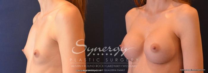 Before & After Breast Augmentation Case 645 View #2 View in Austin, TX