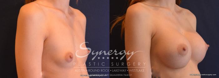 Before & After Breast Augmentation Case 645 View #4 View in Austin, TX