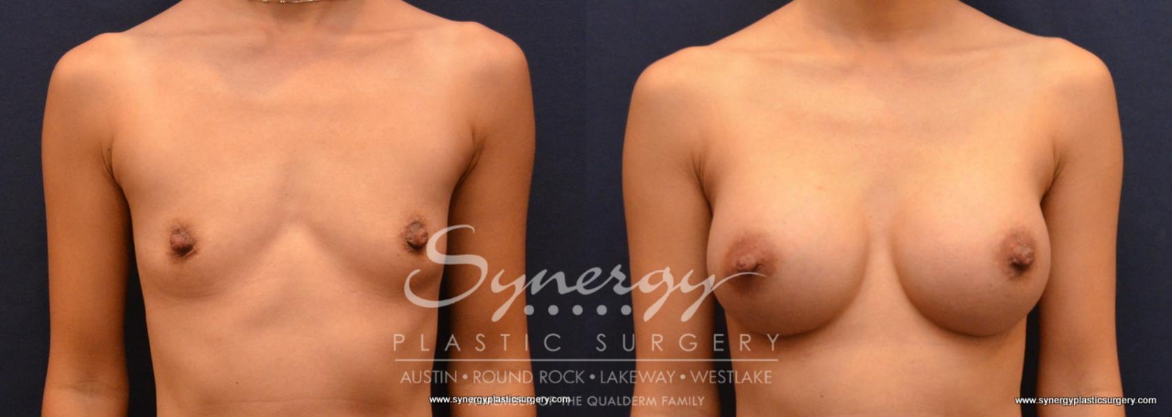 Before & After Breast Augmentation Case 646 View #1 View in Austin, TX