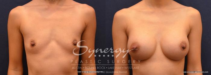 Before & After Breast Augmentation Case 646 View #1 View in Austin, TX