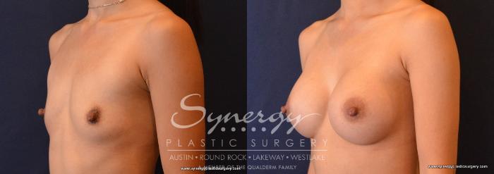 Before & After Breast Augmentation Case 646 View #2 View in Austin, TX