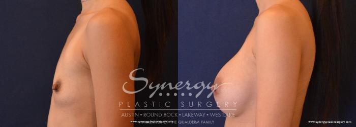 Before & After Breast Augmentation Case 646 View #3 View in Austin, TX