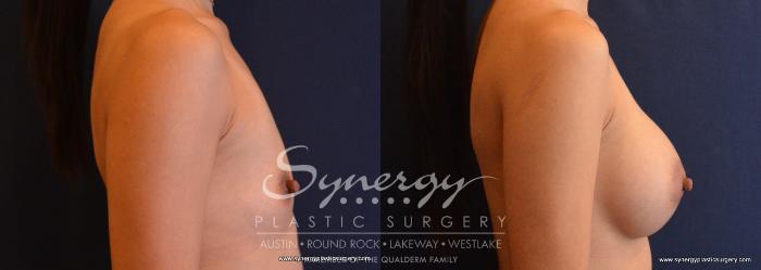 Before & After Breast Augmentation Case 646 View #4 View in Austin, TX