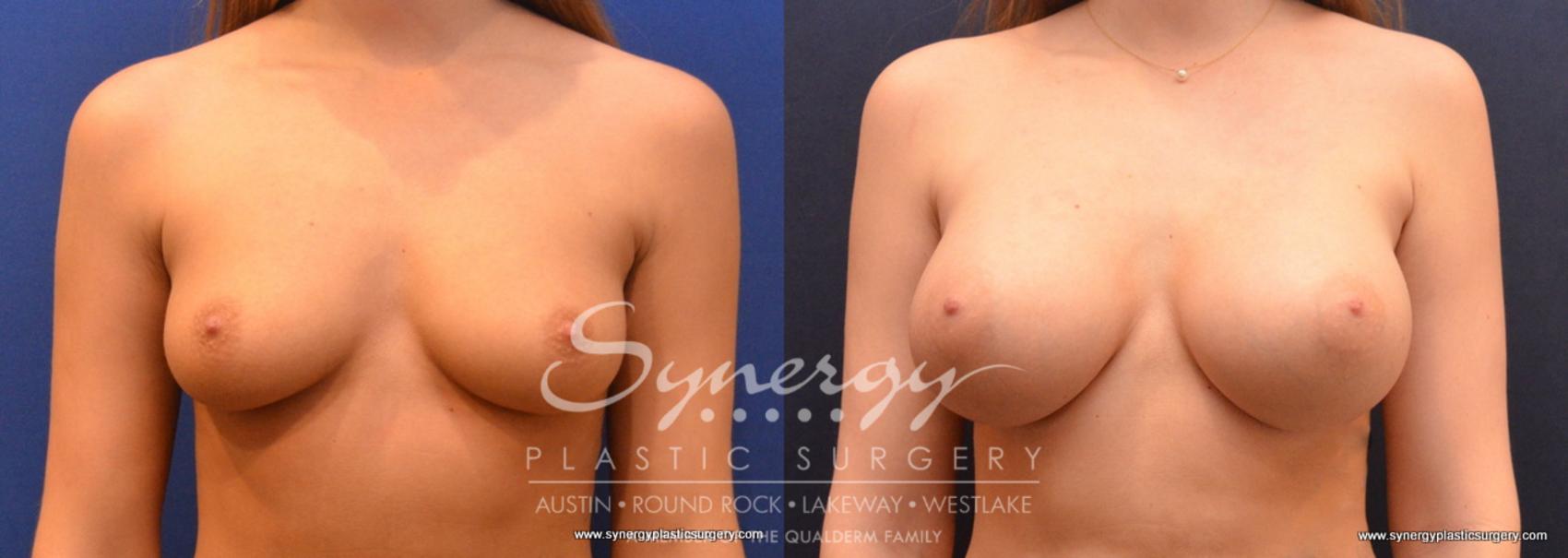 Before & After Breast Augmentation Case 649 View #1 View in Austin, TX