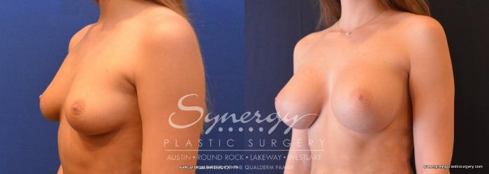 Before & After Breast Augmentation Case 649 View #2 View in Austin, TX