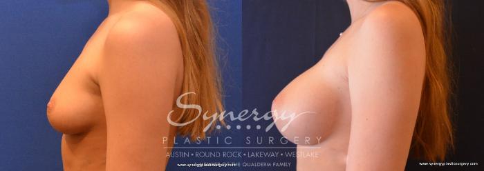 Before & After Breast Augmentation Case 649 View #3 View in Austin, TX