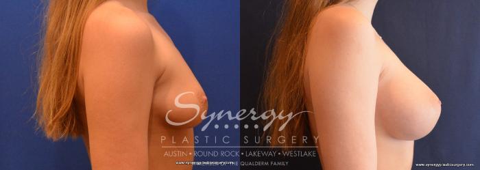 Before & After Breast Augmentation Case 649 View #5 View in Austin, TX