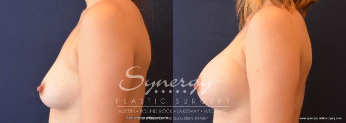 Before & After Breast Augmentation Case 650 View #3 View in Austin, TX