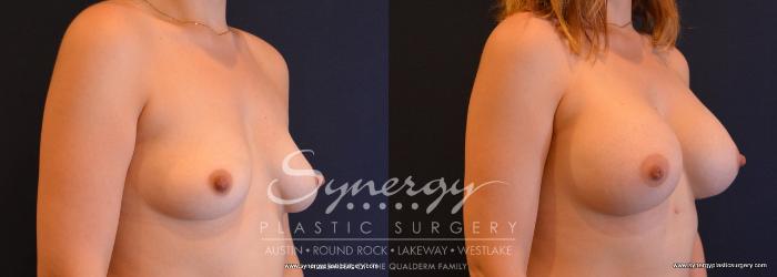 Before & After Breast Augmentation Case 650 View #4 View in Austin, TX