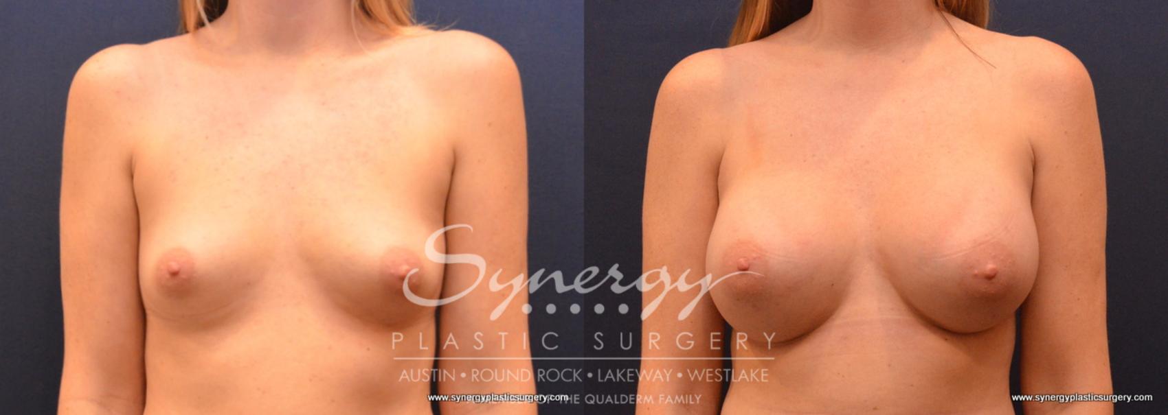 Before & After Breast Augmentation Case 653 View #1 View in Austin, TX