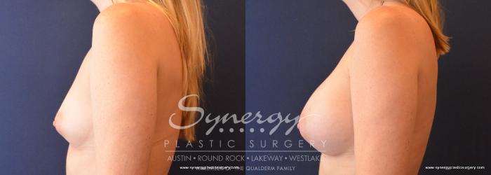 Before & After Breast Augmentation Case 653 View #2 View in Austin, TX