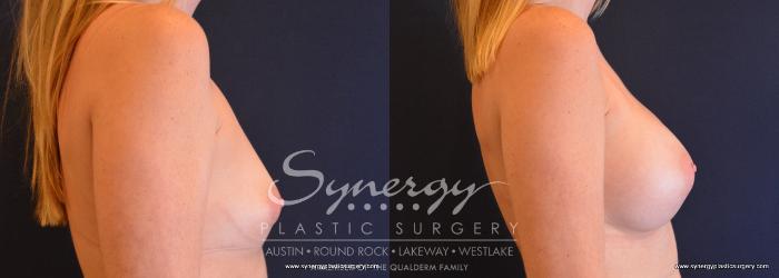 Before & After Breast Augmentation Case 653 View #5 View in Austin, TX