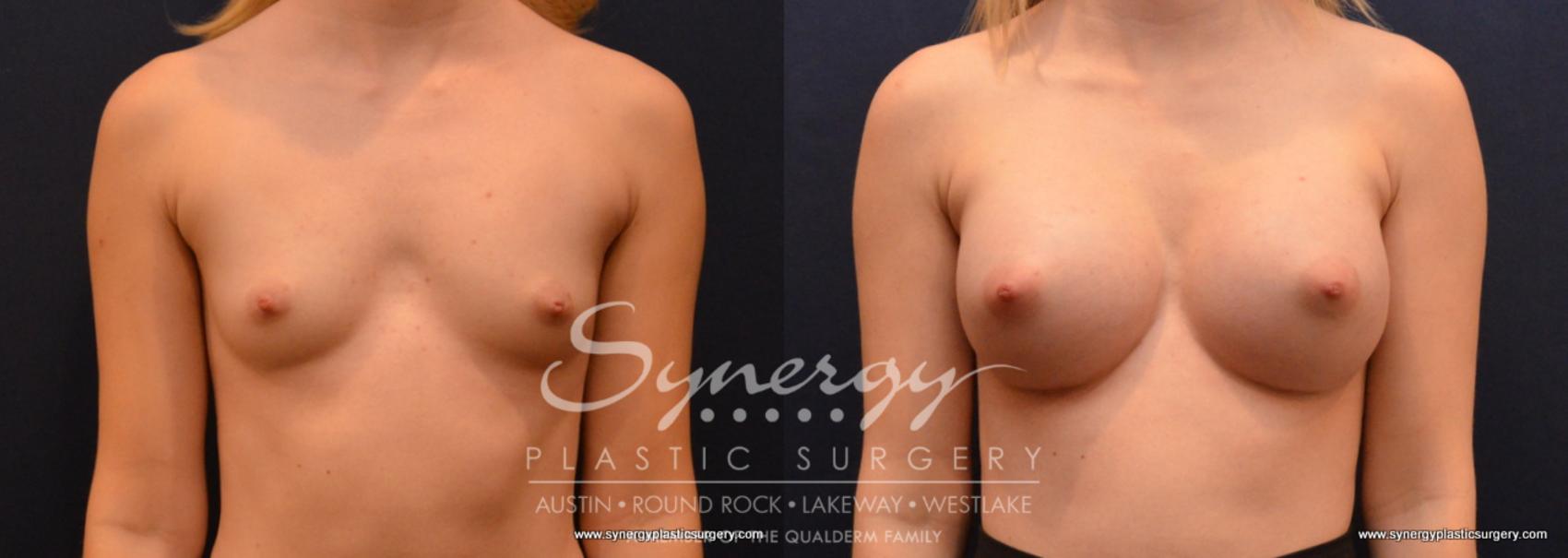 Before & After Breast Augmentation Case 654 View #1 View in Austin, TX