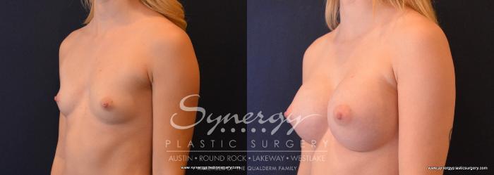 Before & After Breast Augmentation Case 654 View #2 View in Austin, TX